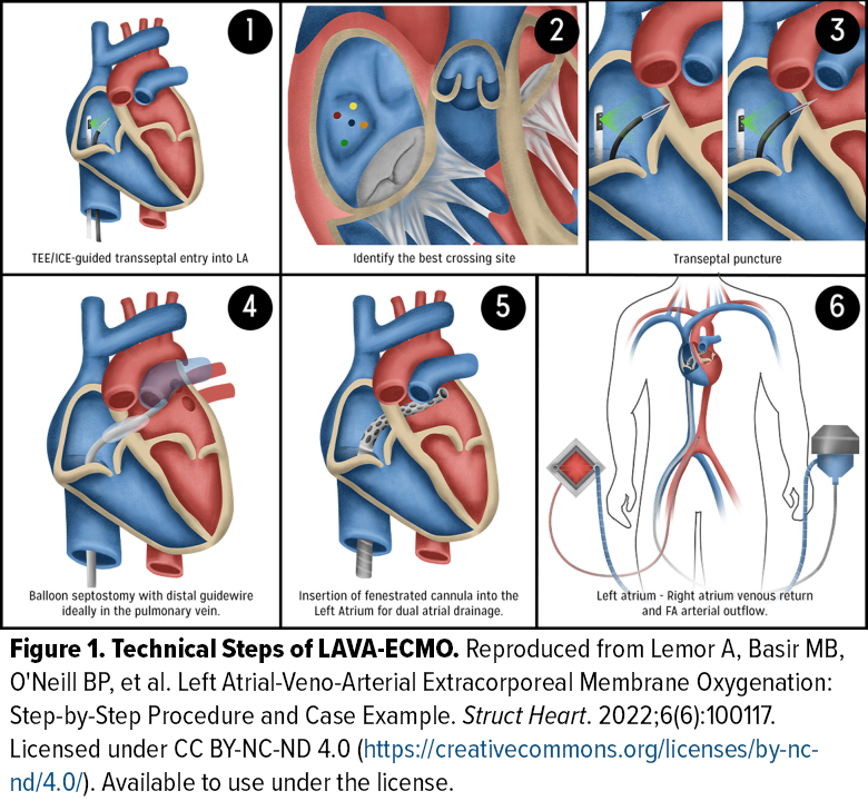 ECMO 2.0: What's LAVA Got to Do With It? A Rapid-Fire Introduction to ...